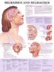 Migraine and headache chart is ideal for patient education
