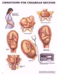 Cesarean sections and what leads to them